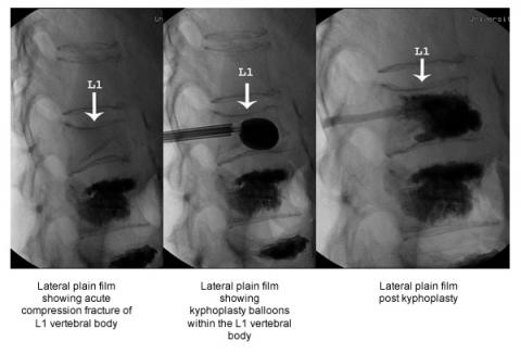 Compression Fractures pre and post kyphoplasty