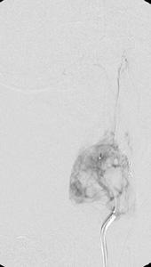 Microcatheter injection in the carotid body tumor again showing the tumor vascular blush 