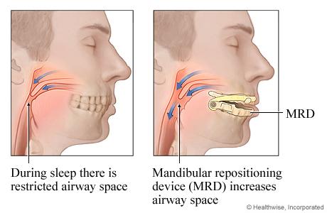Illustration showing side view of heads with restricted airway space and with dental device increasing airway space