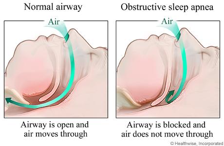 Drawings of side view of heads showing obstructed airway and normal airway