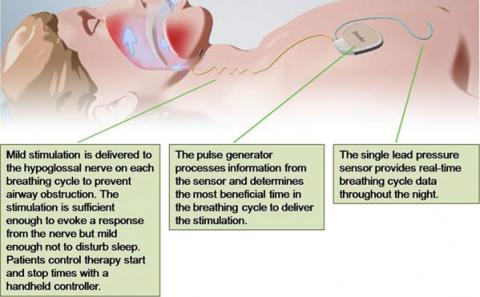 Illustration showing patient with nerve stimulator implanted and text explaining how it works