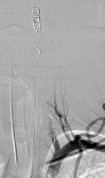 AP left vertebral angiogram after vessel sacrifice showing no flow within the left vertebral artery  