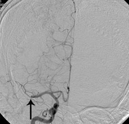 An image from cerebral angiogram in a patient with stroke demonstrates complete occlusion of right middle cerebral artery by a blood clot (arrow)