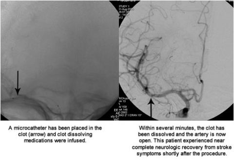 left image: A microcatheter has been placed in the clot (arrow) and clot dissolving medications were infused. , Right image: Within several minutes, the clot has been dissolved and the artery is now open. This patient experienced near complete neurologic 