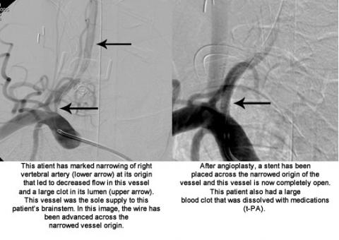 Stenting and Angioplasty image