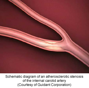 Schematic diagram of an atherosclerotic stenosis of the internal carotid artery (Courtesy of Guidant Corporation)