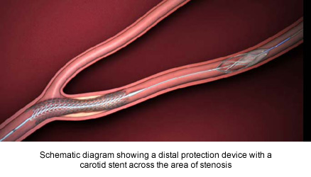 Schematic diagram showing a distal protection device with a carotid stent across the area of stenosis   