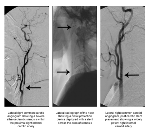 Carotid angiograms