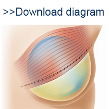 Implant thumb image