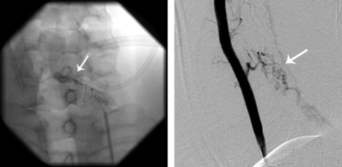 Spinal Cord AVM